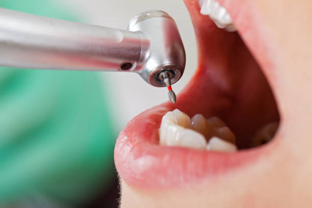 Best Emergency Tooth Extraction in Pelzer, SC